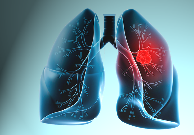 Akciğer Kanserine Çözüm